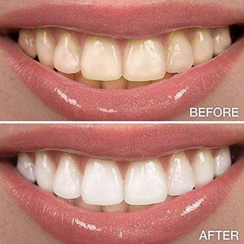 XL (1) Teeth Whitening Pen 4cc (not 2cc) of 22% Carbamide Peroxide Tooth Whitener Stain Remover Gel. Natural Mint, no Sensitivity, Made in The USA.